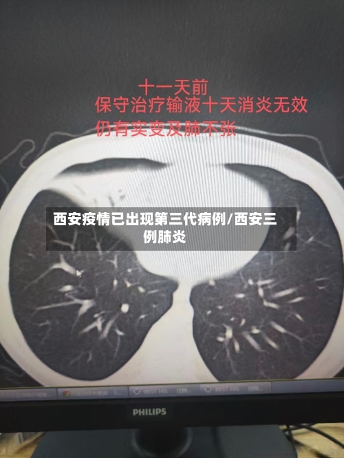 西安疫情已出现第三代病例/西安三例肺炎