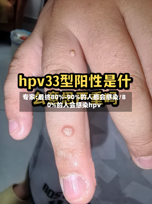 专家:最终80%-90%的人都会感染/80%的人会感染hpv-第3张图片