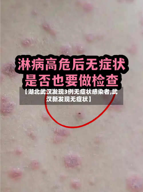 【湖北武汉发现3例无症状感染者,武汉新发现无症状】-第3张图片