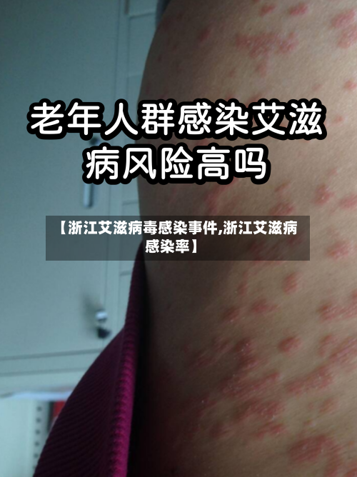 【浙江艾滋病毒感染事件,浙江艾滋病感染率】-第3张图片