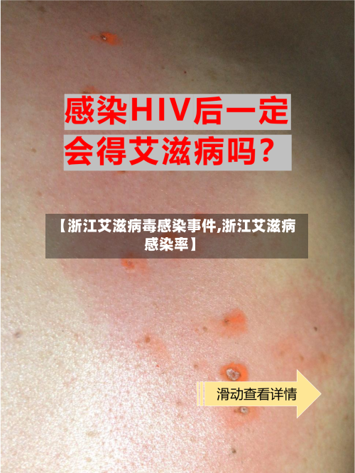 【浙江艾滋病毒感染事件,浙江艾滋病感染率】-第2张图片