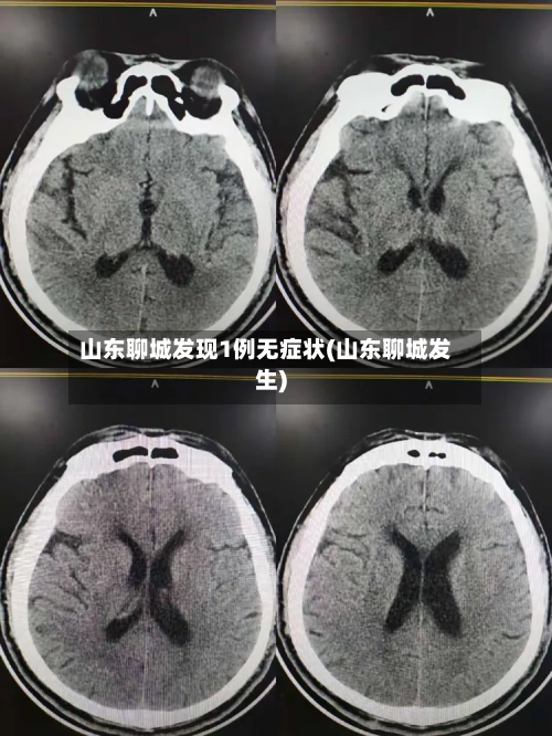 山东聊城发现1例无症状(山东聊城发生)-第3张图片